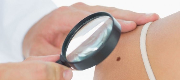Rritja e vetëdijes për melanoma: Fushata EURO MELANOMA 2026 në Shkup 