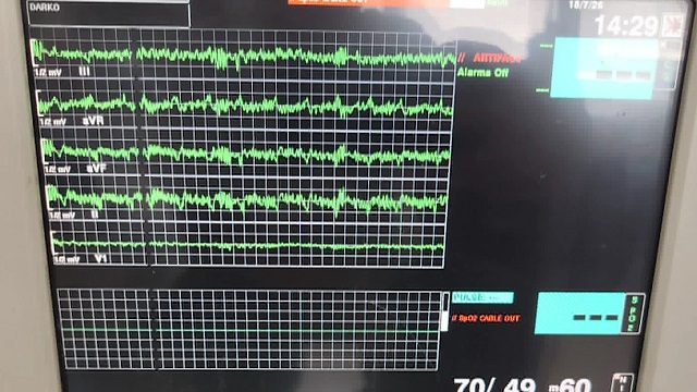 Të rinj që prej vitesh presin transplant të zemrës